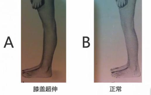 膝盖向里凹怎么矫正,影响身高的体态问题有哪些