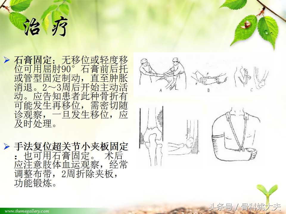 儿童肱骨干骨折处理方法,小孩胳膊肱骨骨折恢复最佳的方法