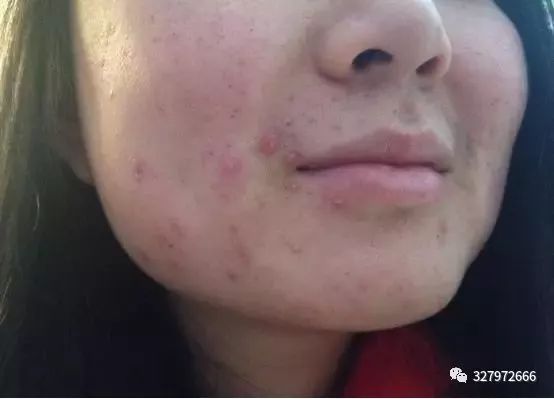 祛痘，丘疹型*疮痤**的治疗和护理