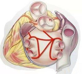 心脏房颤引起的脑梗该怎么治疗,医学教授讲治疗心脏房颤视频