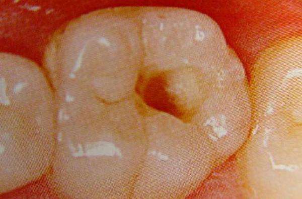 牙齿掉了什么时候补牙最好,牙齿缺了一半补牙要多少钱