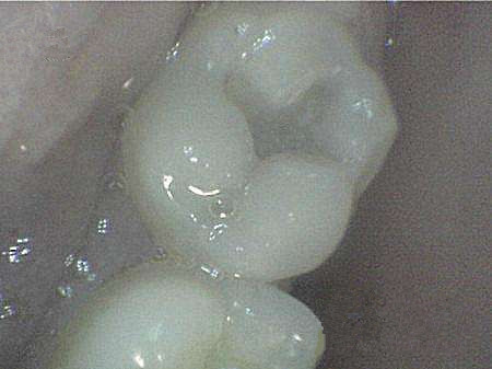 牙齿掉了什么时候补牙最好,牙齿缺了一半补牙要多少钱