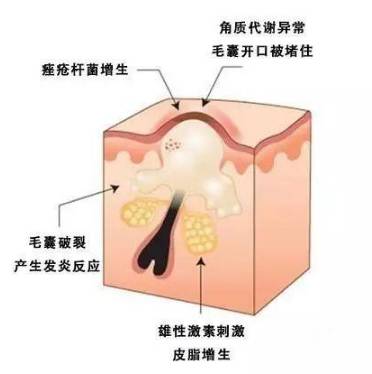 脸上闭口粉刺痘痘毛孔粗大怎么办,脸上长好多闭口粉刺还能敷面膜吗