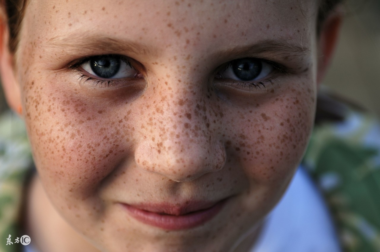 雀斑的形成原因及去除方法,如何避免7岁儿童遗传雀斑