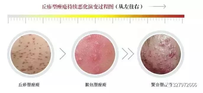 祛痘，丘疹型*疮痤**的治疗和护理