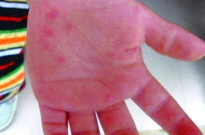 治疗手足口病，利巴韦林扮演着怎样的角色