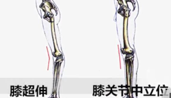膝盖向里凹怎么矫正,影响身高的体态问题有哪些