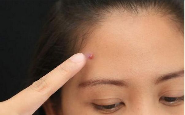 女人外面长什么痘,里面就有什么病!你造吗?