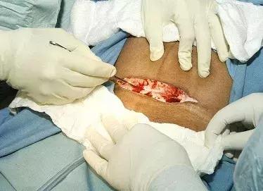 哪些明星做过剖宫产,为什么明星都选择剖宫产