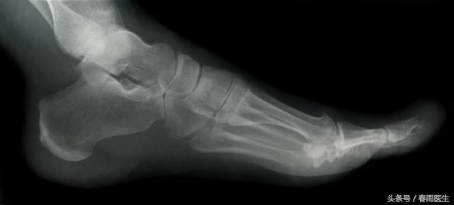 奚梦瑶维密大秀意外摔倒,奚梦瑶维密秀摔倒原因