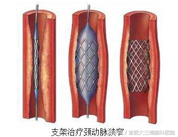 中年人半边身体麻木怎么回事,人到中年眼花