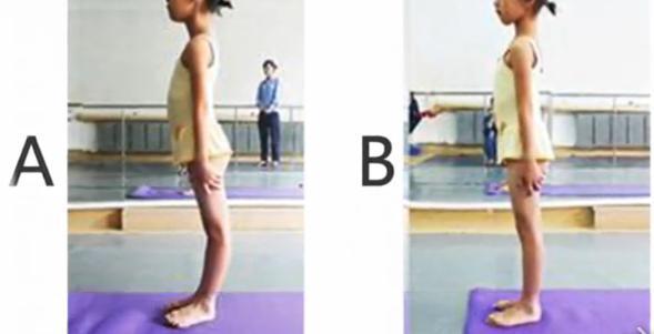 膝盖向里凹怎么矫正,影响身高的体态问题有哪些