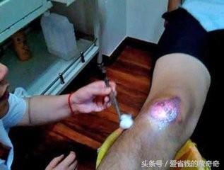 狗狗被大狗咬伤会应急吗,被自家狗狗咬伤了要打针吗