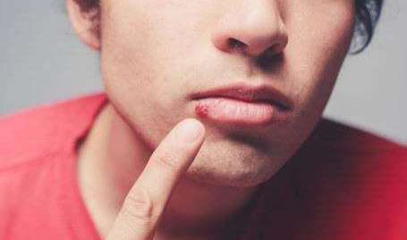 「美肤颜习会」冬天嘴角干裂不要舔，两个小绝招让你安然过冬！