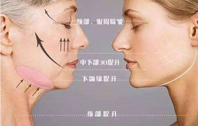 经常做线雕对面部抗衰有哪些帮助,线雕抗衰