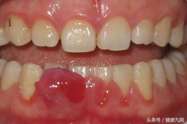 谈口腔病的最佳治疗,浅析牙龈炎治疗与预防文献