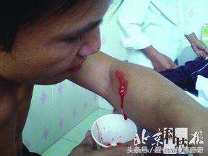 狗狗被大狗咬伤会应急吗,被自家狗狗咬伤了要打针吗