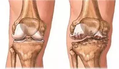 骨刺不治疗能不能自己好,年轻人骨刺怎么治才能彻底根除