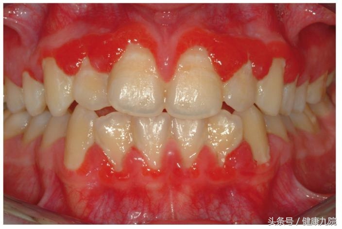 谈口腔病的最佳治疗,浅析牙龈炎治疗与预防文献