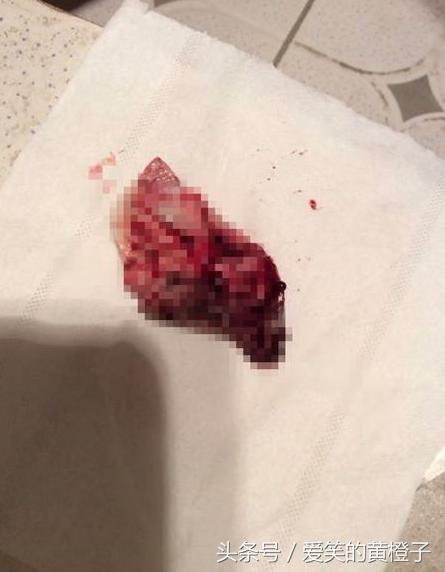 产妇生完孩子15天掉出一块肉,顺产第七天掉出一块肉