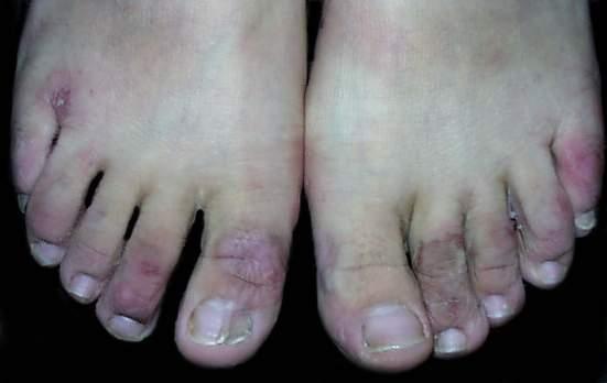 冻疮会一下子肿起来吗,冻疮会使手变粗