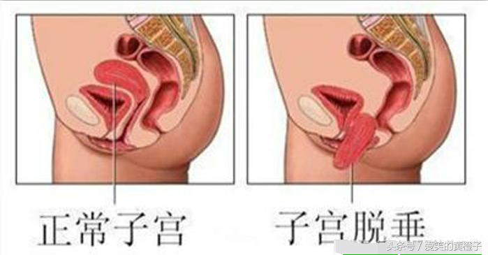 产妇生完孩子15天掉出一块肉,顺产第七天掉出一块肉