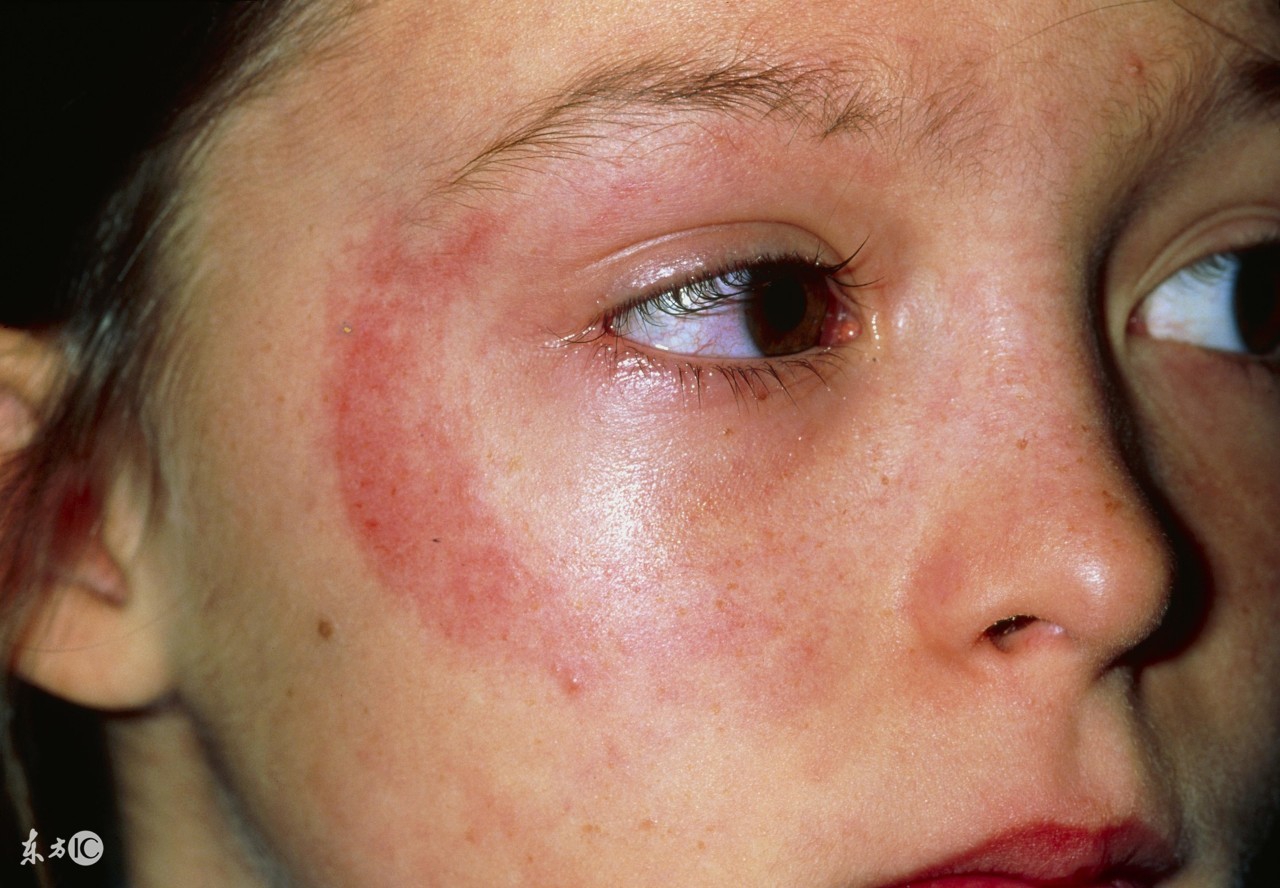 皮肤过敏拔罐治疗有效吗,上海皮肤过敏有效治疗办法