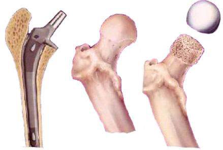 髋关节股骨头坏死四个严重误区,股骨头坏死恐慌怎么办