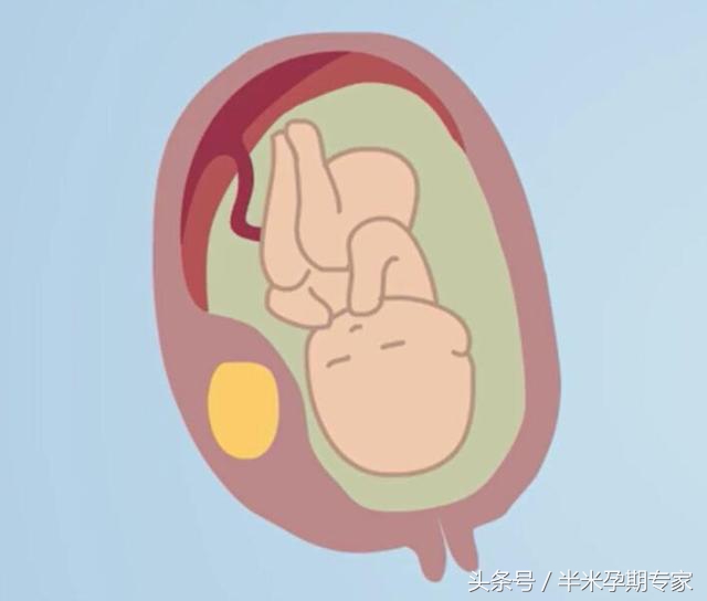 子宫肌瘤吃什么药能怀孕,怀孕有子宫肌瘤怎么办