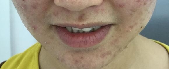 下巴反复长白头粉刺是激素痘吗,下巴有很多小白头粉刺怎么回事