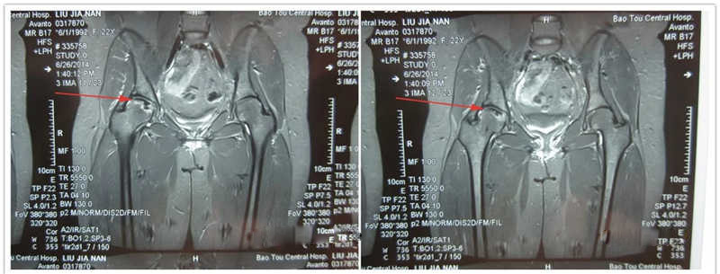 髋关节股骨头坏死四个严重误区,股骨头坏死恐慌怎么办
