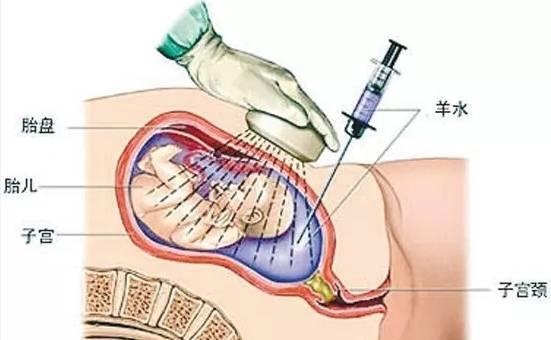 准妈妈们您做唐氏筛查了吗,带你全面了解唐氏综合征