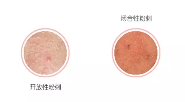 治疗闭口粉刺的中药,治疗闭口粉刺最有效的方法
