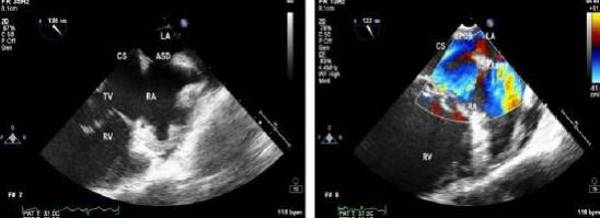 程云阁：患儿房缺1.6mm几岁可以手术？什么情况下可以自愈？