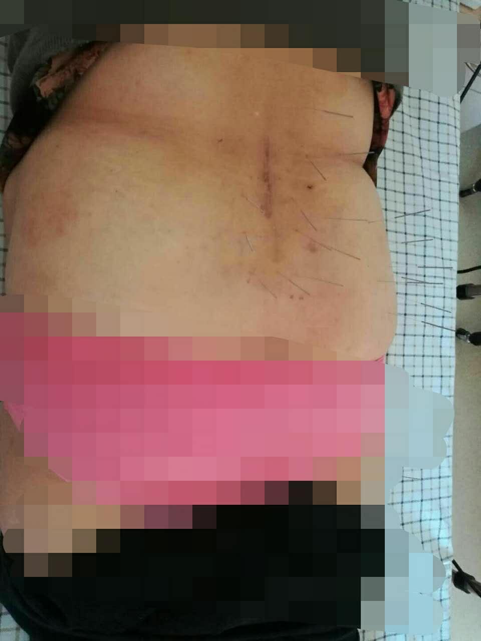 中医针灸腹针,中医大神针