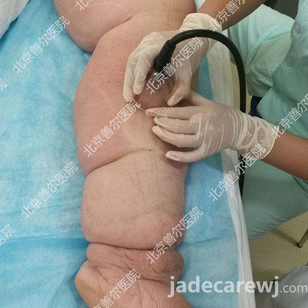 案例分享：乳腺癌术后5年、上肢淋巴水肿的治疗