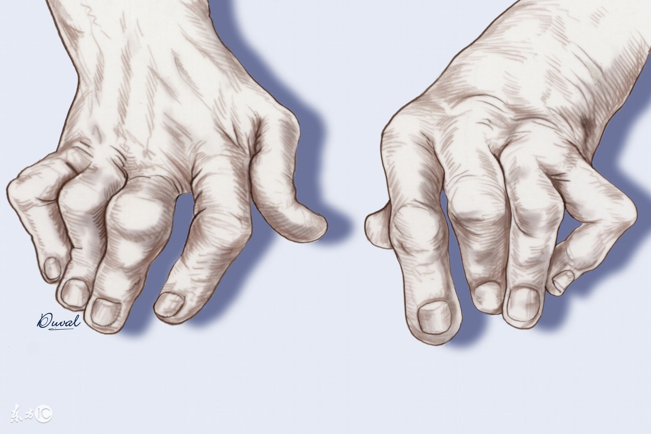 尿酸高了怎么办？如何调理？痛风可以根治吗？