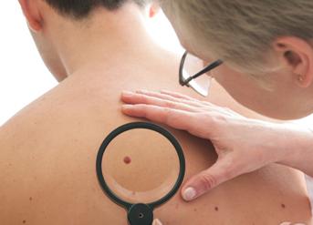 种痣的方法和技巧,自己祛痣小妙招几天就没了