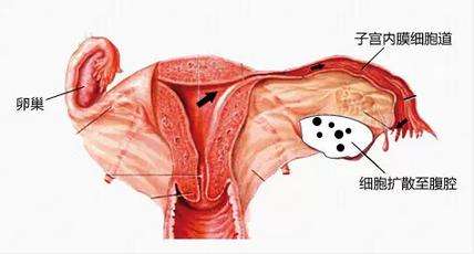 有人子宫内膜异位症怀孕了吗,子宫内膜异位症影响怀孕吗