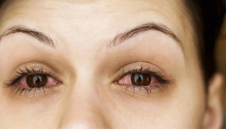 眼睛变红快速治疗方法,眼睛变红的小技巧