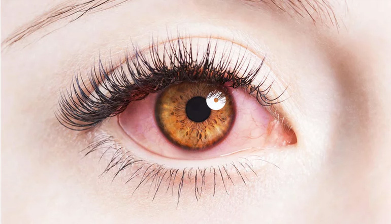 眼睛变红快速治疗方法,眼睛变红的小技巧