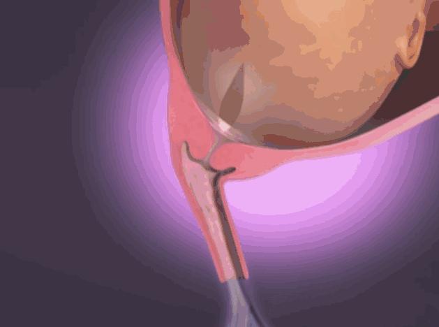 临产的三大征兆规律性宫缩,临产的三大征兆宫缩见红破水