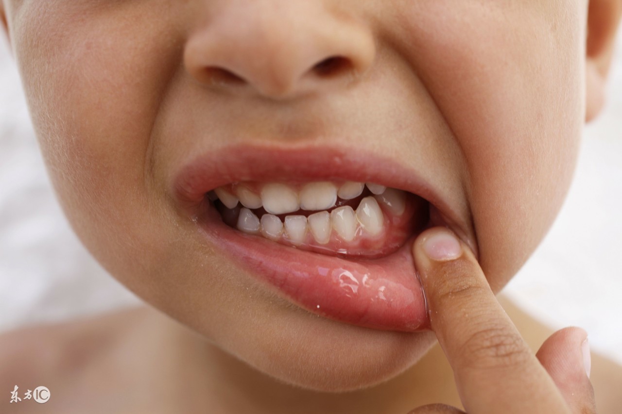 小孩子牙齿长黑渍怎么治疗,儿童牙齿有黑渍要去看医生吗