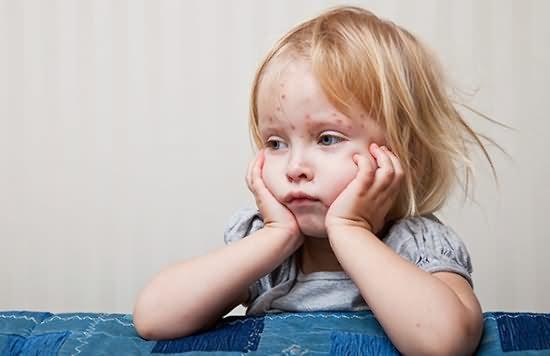 小孩长水痘能吹风吗,小孩长水痘会留疤吗