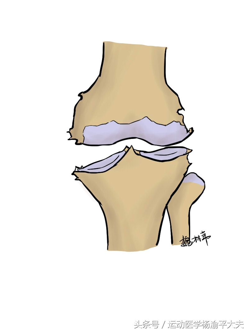 什么情况属于滑膜炎,滑膜炎的概念是什么