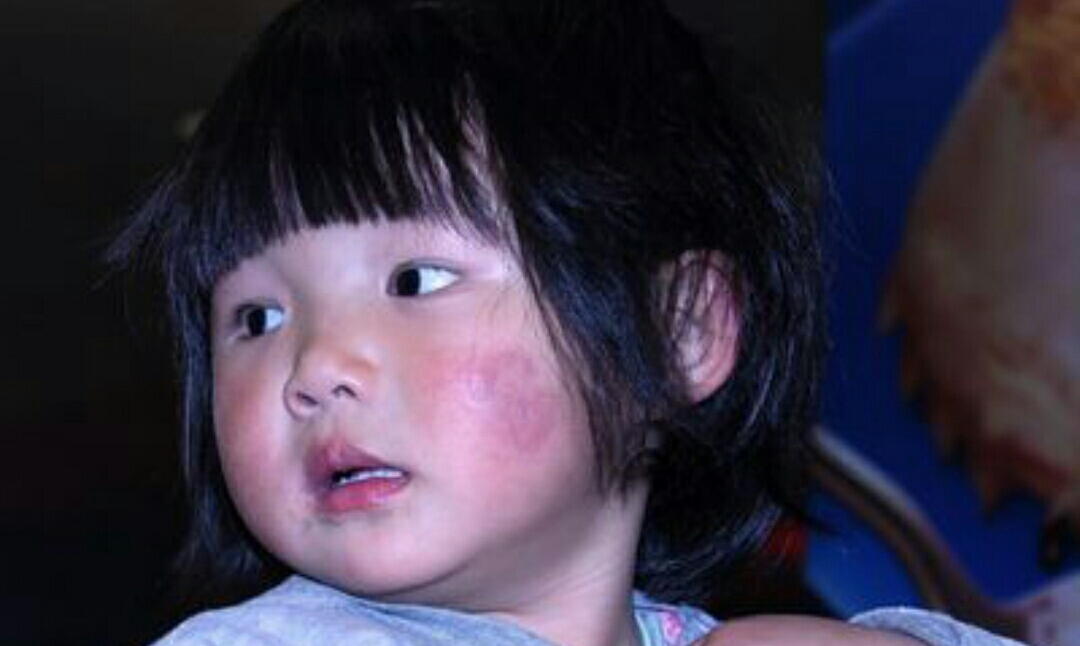 冻伤疮什么意思,冻疮的治疗方法