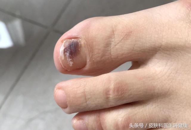 甲下黑色素瘤会不会指甲一夜变黑,指甲发黑是大脑血管有杂质吗
