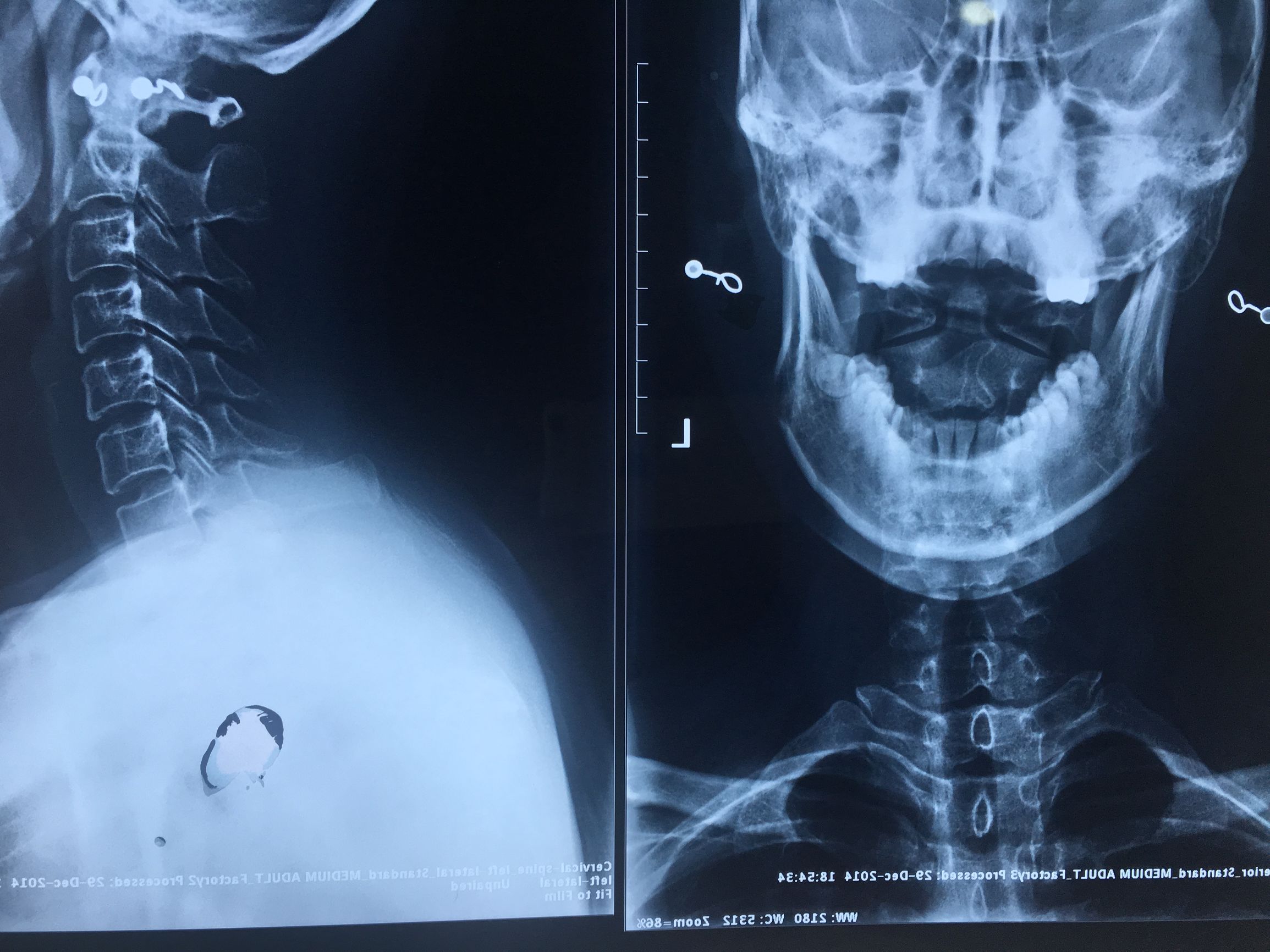 为什么脊椎病首选美式整脊治疗?