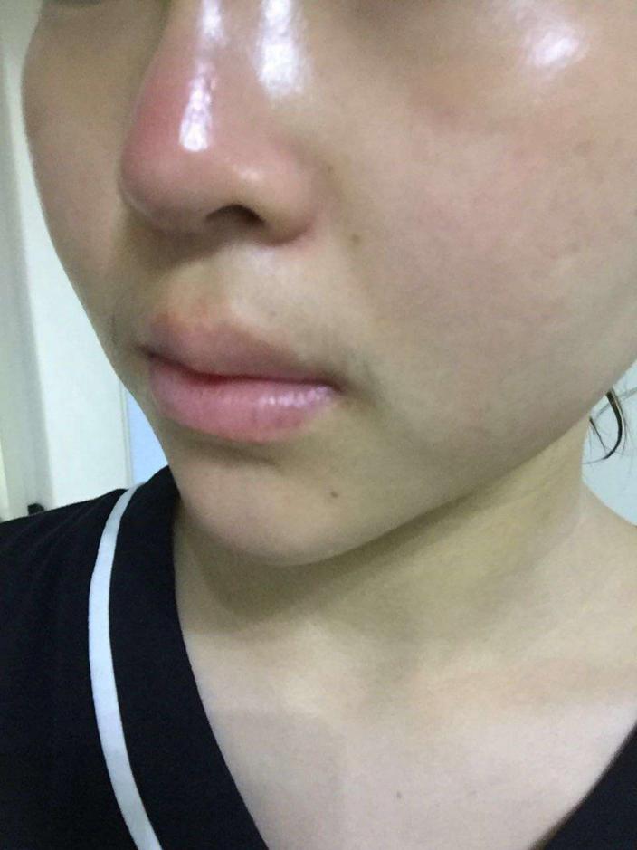 网友再曝欧兰整形手术问题做完整形后鼻涕流不出