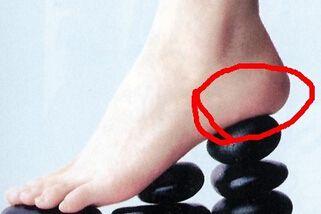 什么东西可以治脚跟裂,治脚跟裂用什么药膏好用